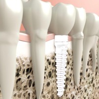 Implantat - © beawolf - Fotolia.com